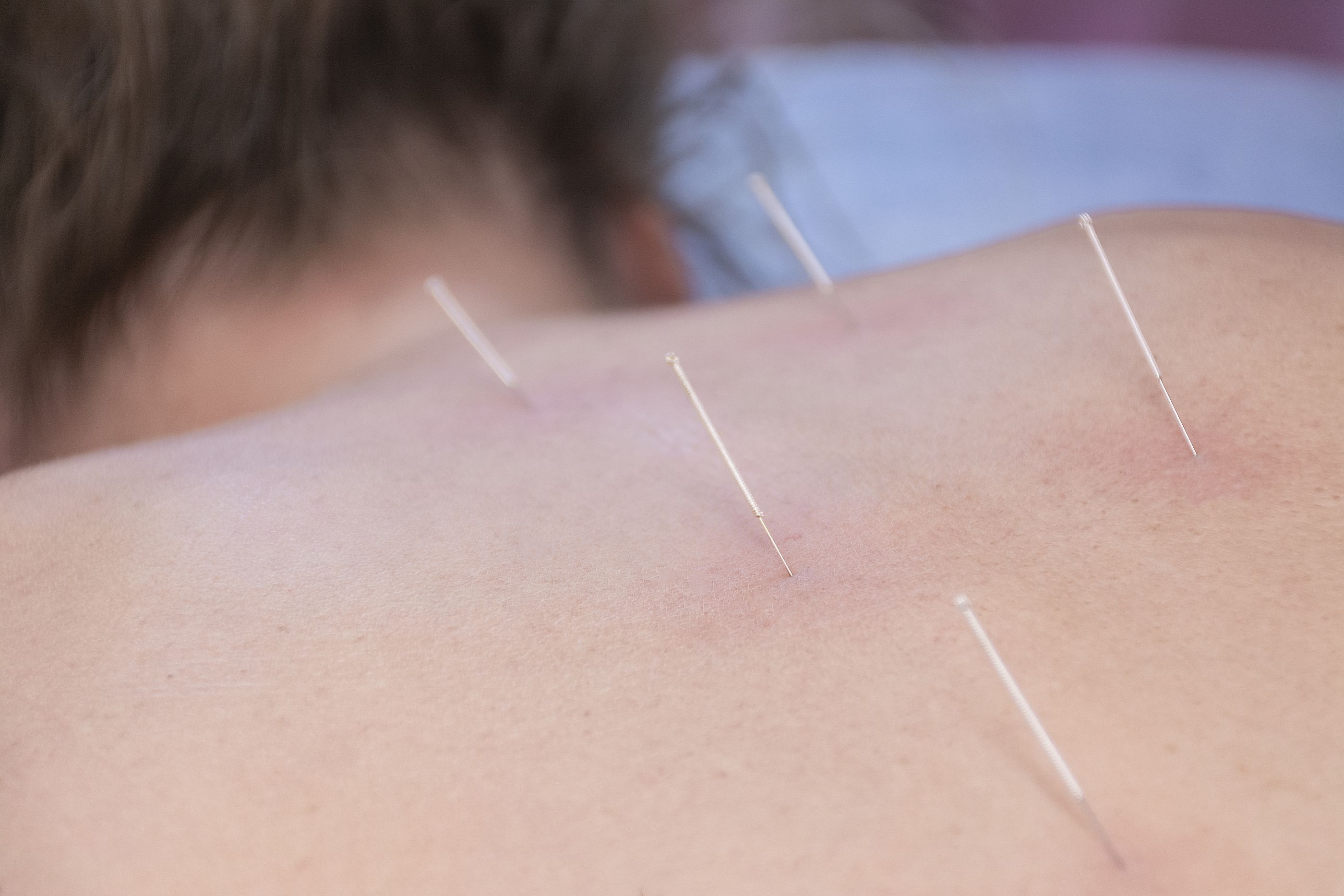 Vantaalainen fysioterapeutti Pasi Sinisalo on tehnyt kuivaneulauksen asiakkaan yläselän jumituksen ja niska-hartiakivun hoitoon.